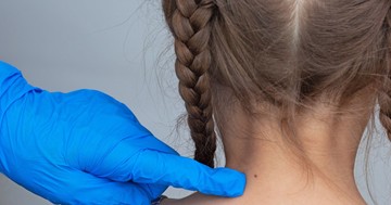  Mikor kell először elvinni a gyereket anyajegyszűrésre? 