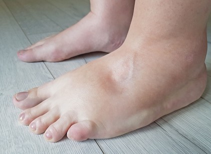 Nyomja meg pár másodpercre a bokáját: ha mélyedés marad utána, szívbetegség is állhat a háttérben című cikk nyitóképe