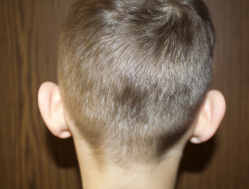 orvos valaszol elálló fül kezelése