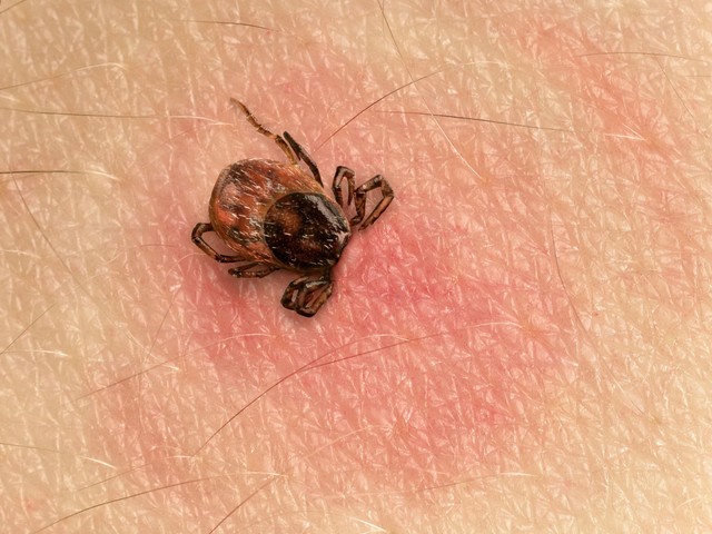Lyme-kór: ezek a kullancscsípés utáni első tünetek