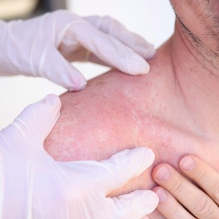 Mi a különbség a melegkiütés és a napallergia között? Bőrgyógyász mondja el című cikk nyitóképe