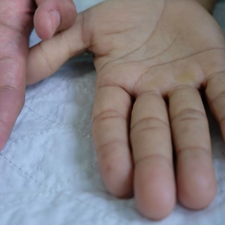 Megaloblasztos anémia tünetei, vizsgálata és kezelése című cikk nyitóképe