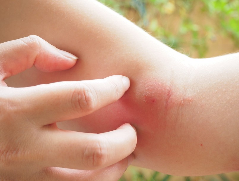 Szúnyogcsípés, darázscsípés ellen házi módszer