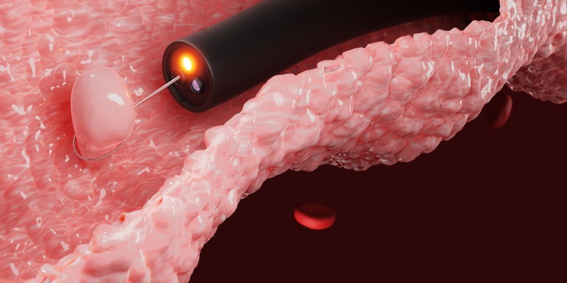A vastagbélpolipok számával arányosan nő a rák esélye? Az orvos válaszol