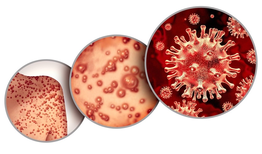 A koronavírusoknál már megszokhattuk, hogy egy-egy víruscsoport nagyon sokféle taggal és különféle tulajdonságú, kockázatú vírusokat tartalmazhat. A Poxviridae család is egy hatalmas víruscsalád, ezen belül az úgynevezett Orthopoxvirus vírok közé tartozik a Majomhimlő vírus is. Tipikus zoonótikus (tehát állatról emberre terjedő fertőzés) vírus, legvalószínűbb természetes gazdái Közép – és Nyugat-Afrikában élő rágcsálók, közöttük tünetmentesen terjed és fennmarad a vírus.