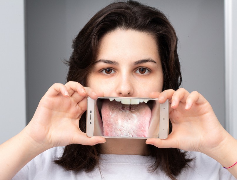 Szájpenész, oka, tünetei, kezelése, Candida albicans, Candida, fertőzés, gomba