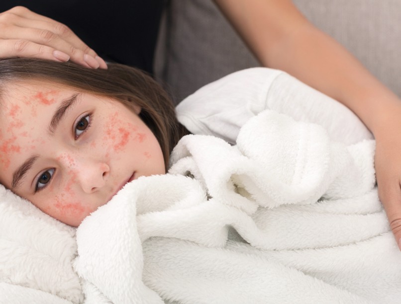 kanyaró járvány, Románia, oltás