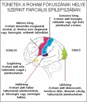 Epilepszia: parciális és generalizált rohamok