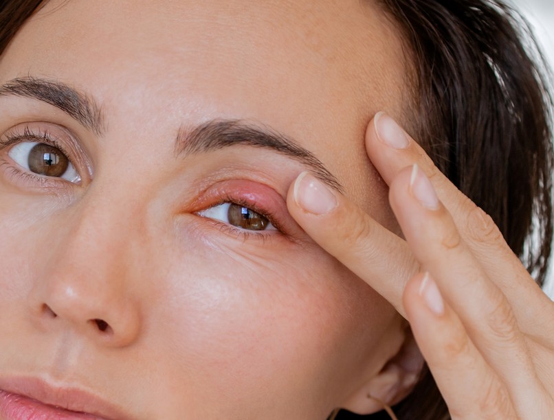 szemfertőzés szem bakteriális fertőzése