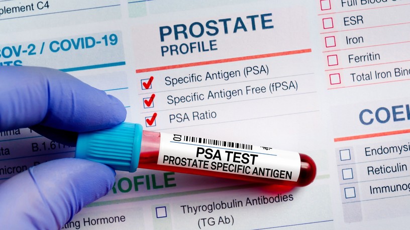 PSA vizsgálat szűrés prosztatarák férfi