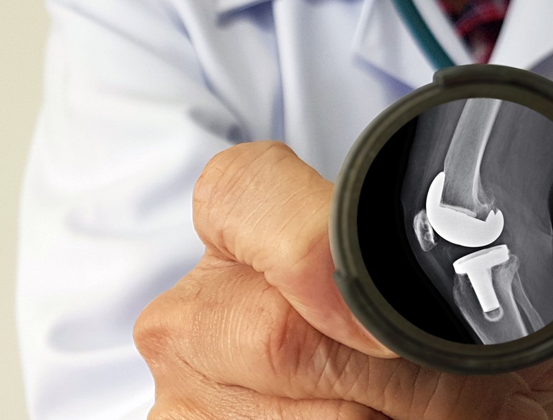 műtéti beavatkozás Mennyi ideig tart felépülni csípőprotézis térdprotézis után