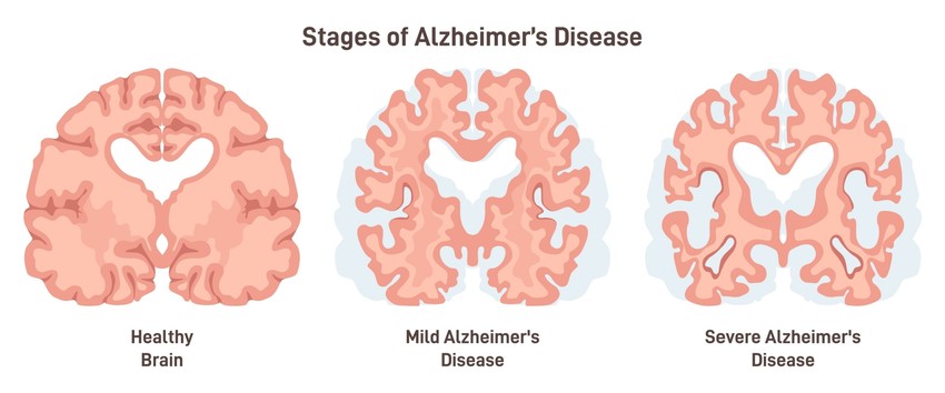 Bár az Alzheimer kórban az idegsejtek pusztulásának okát nem tudjuk megmondani, felvetődött, hogy a beta-amyloid egy bizonyos formája okozhatja. Amyloid prekurzor (előalak, képző) fehérje, valamint a preszenilin 1 és preszenilin 2 fehérjék bizonyos genetikai mutációi (a gén örökíthető megváltozásai) korai kezdetű Alzheimer betegséghez vezethetnek. Ezek a mutációk amyloid plakkok kialakulását eredményezik.