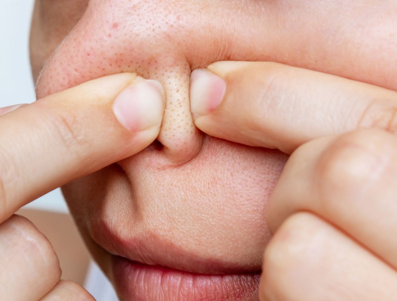 miteszer, pattanás, kinyomás, bőrprobléma