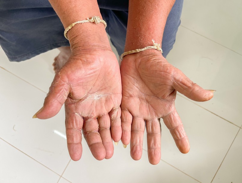 scleroderma bőrbetegség hatása tüdő, szív vese egészsége