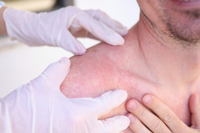 Mi a különbség a melegkiütés és a napallergia között? Bőrgyógyász mondja el