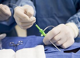 Érsebészet: műtét varratok nélkül?