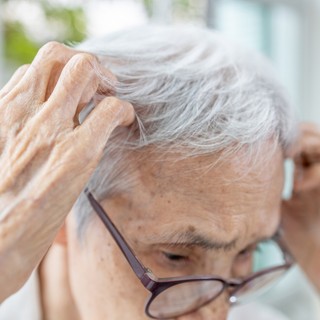 Sárgás, hámló lerakódás a fejbőrön - ez állhat a háttérben című cikk nyitóképe