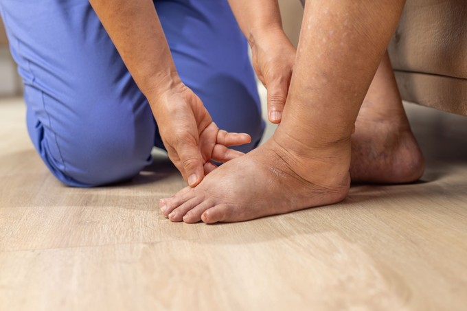 Egyre gyakrabban dagad be estére a lába? Nem biztos, hogy ártalmatlan jelenségről van szó című cikk nyitóképe