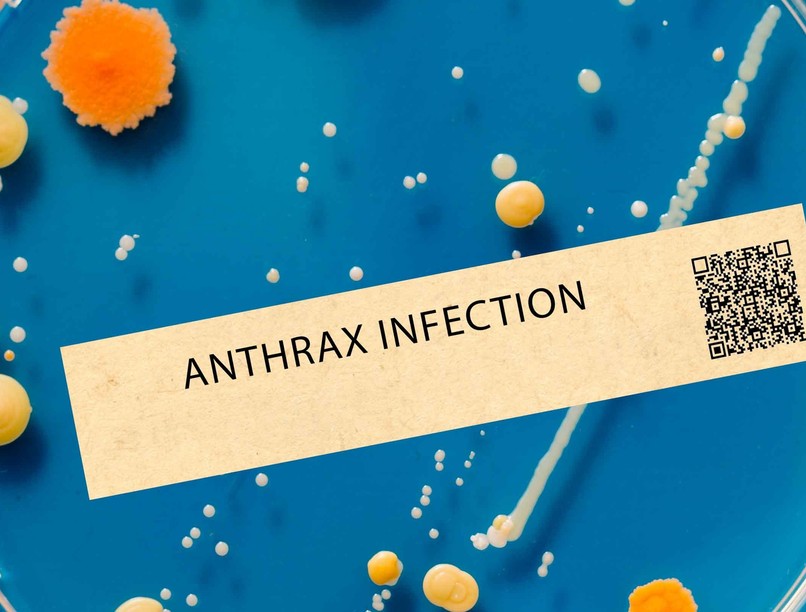 Anthrax (lépfene)