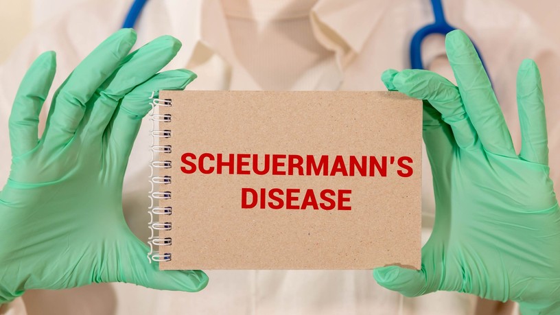 Scheuermann-kór tünet vizsgálat kezelés