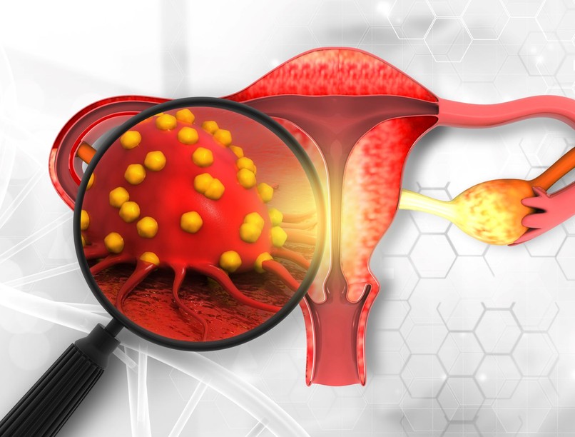 gyakori puffadás okai petefészekciszta hasi fájdalom