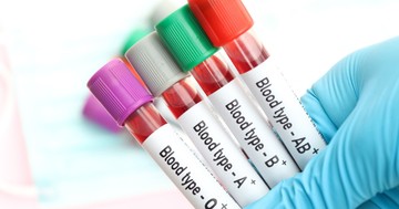  Ha ilyen a vércsoportja, nagyobb eséllyel lesz rákos - állítja egy friss tanulmány 