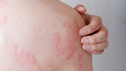 Mire utal a csalánkiütés? című cikk nyitóképe