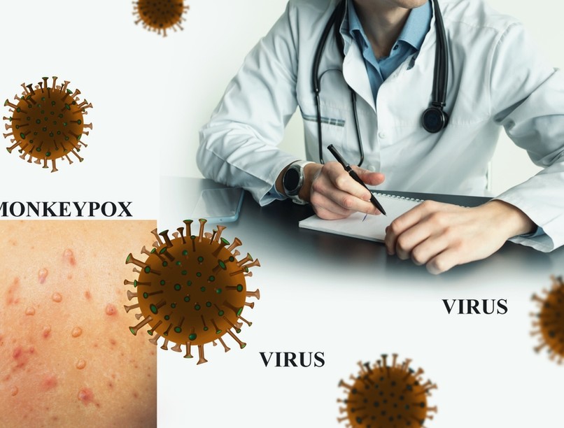 majomhimlő, járvány, majomhimlő tünetei, majomhimlő kezelése, vírus, bárányhimlő