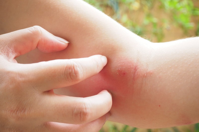 Szúnyogcsípés, darázscsípés esetén ezeket a természetes módszereket próbálja ki!