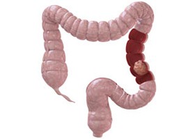 Összefogás a vastagbélrák ellen!