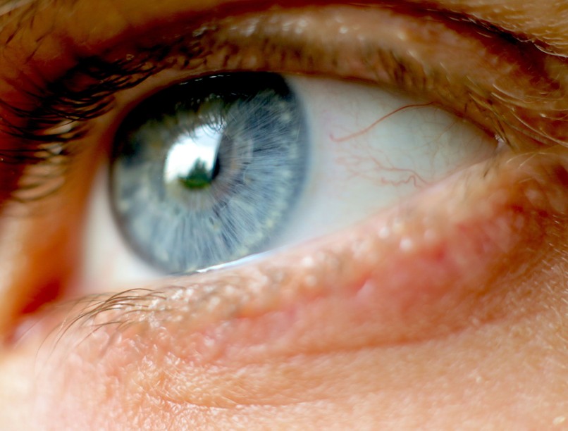 bükki füvesember, szürkehályog, gyulladt, szem gyógynövény