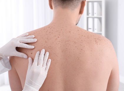 Mennyire veszélyes az anyajegy eltávolítása? Mi az igazság és mi a rémhír? című cikk nyitóképe