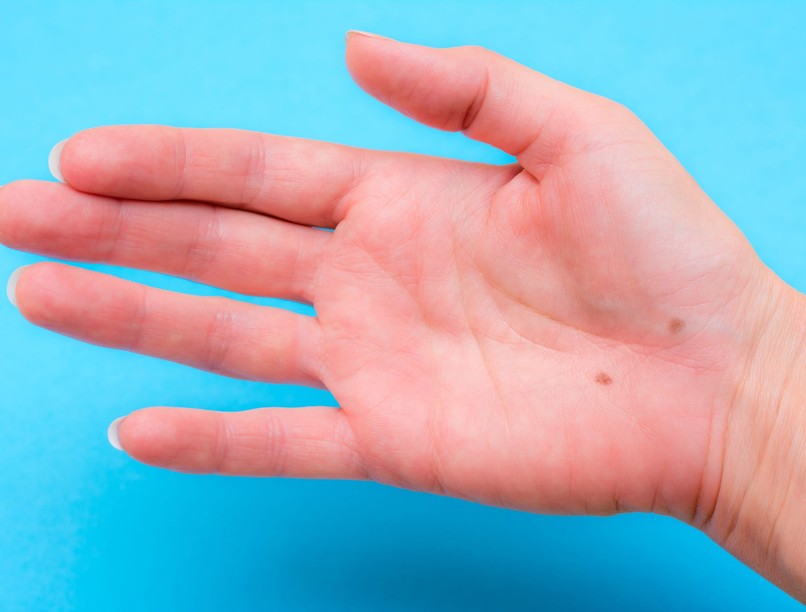 mit jelent anyajegy kézen tenyéren