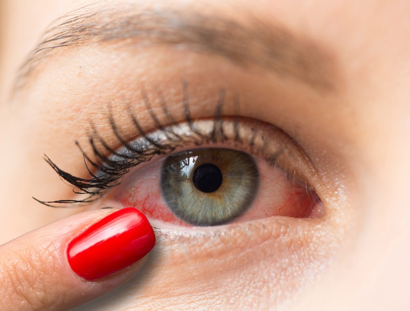 kötőhártya-gyulladás, száraz szem, vörös szem, gyulladás