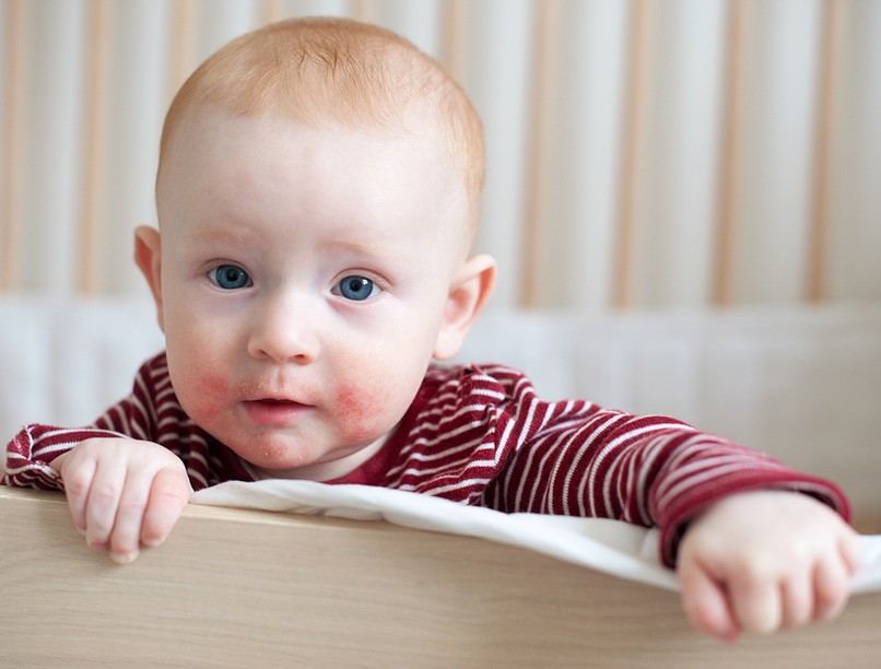 atópiás dermatitisz, ekcéma, atópiás ekcéma, bőrbetegség