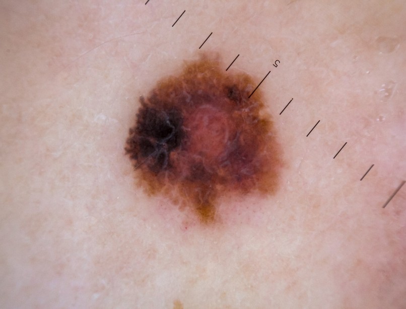 melanóma tünet jel bőrrák fajta forma UV-sugárzás