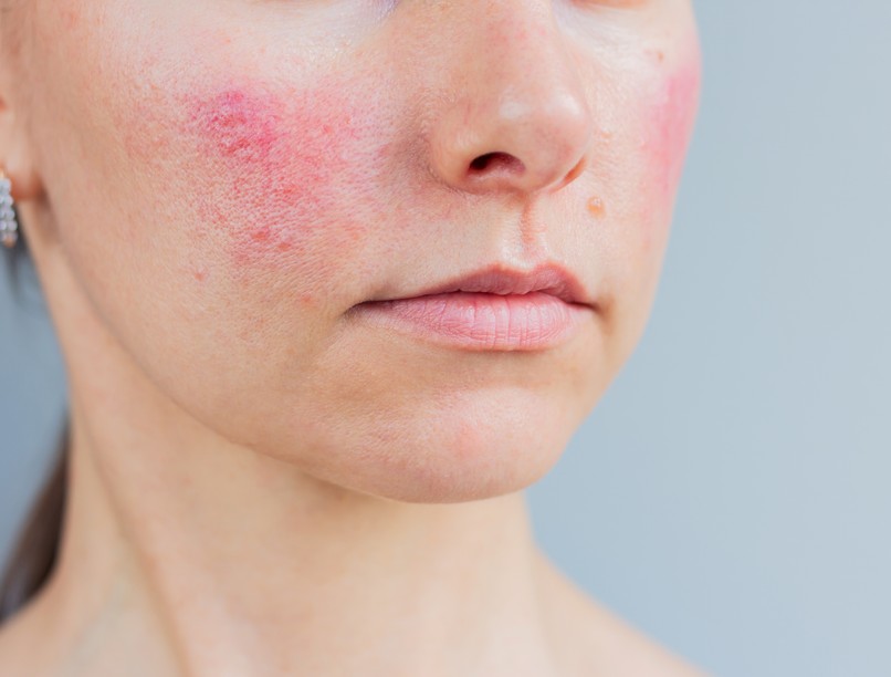 rosacea-arcpir-okok-kuperozis-kezeles