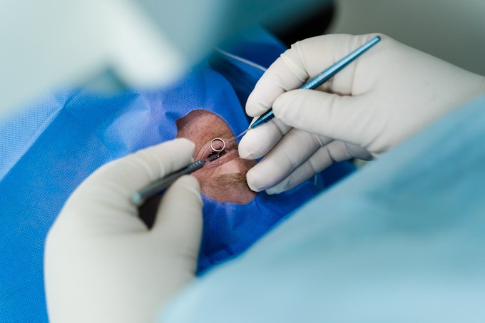 Mi a szürkehályog-műtét? című cikk nyitóképe