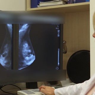 Így segíti a mesterséges intelligencia (AI) az emlőrák kiszűrését című cikk nyitóképe