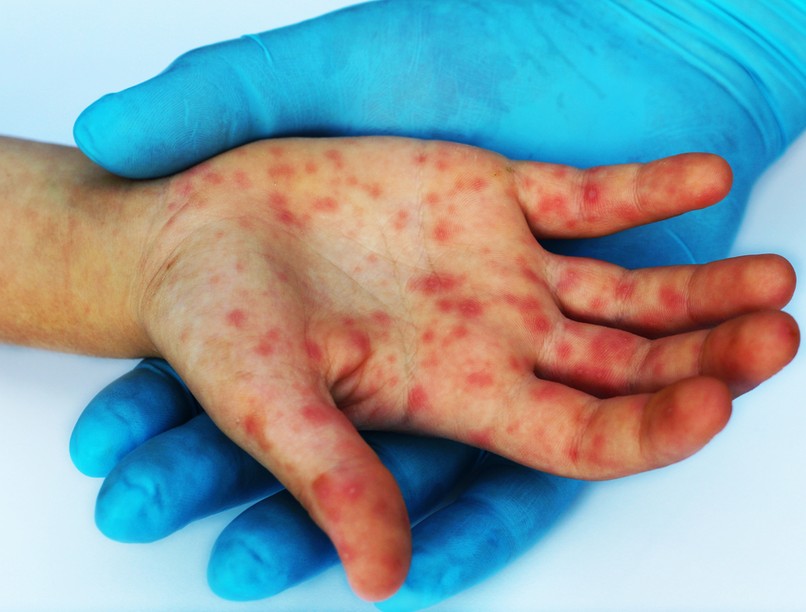 kanyaró elleni védőoltás