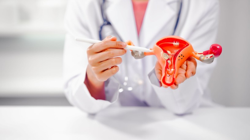 PCOS, tünetei, kezelése, autiumus, várandóság, meddósség
