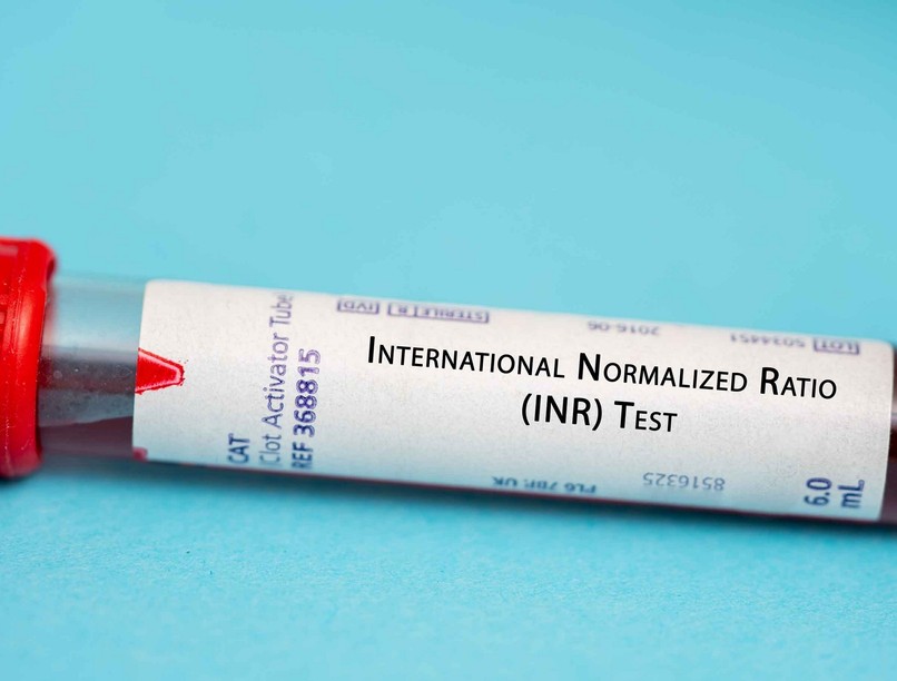 Mit jelent INR érték laborlelet