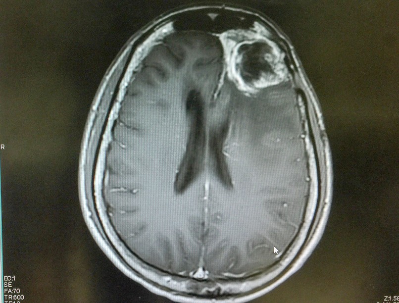 növényi alapú nanorészecske kezelés glioblasztóma ellen