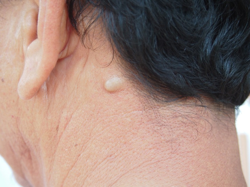 A faggyúmirigy hiperplázia a jóindulatú kis dudor latin neve. Ezek a dudorok olyan károk következményei, amelyek a faggyúmirigy túltermeléséhez vezetnek. A sérült faggyúmirigyek megnagyobbodhatnak vagy eltömődhetnek. Ez puha vagy kemény, fehér vagy sárga felületű dudorokká változtatja őket.