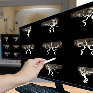 Vérzéses stroke – ez történik, amikor az agyban egy ér megreped című cikk nyitóképe