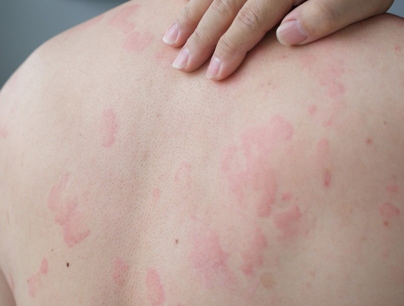 csalánkiütés mennyi idő alatt múlik el