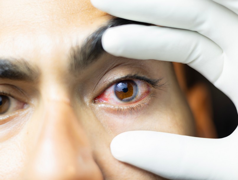 cukorbetegség szem jel tünet