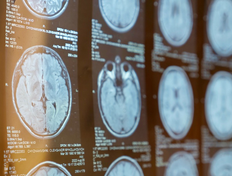 orvostudományi kutatások szklerózis multiplex oka Epstein-barr fertőzés