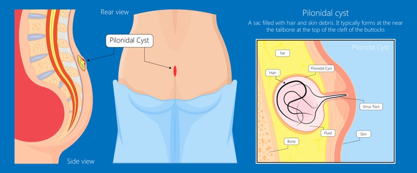 A pilonidális betegség olyan fertőzés, mely a farpofák közti redő felső részén egy szőrszál okozta bőrsérülésből alakul ki.