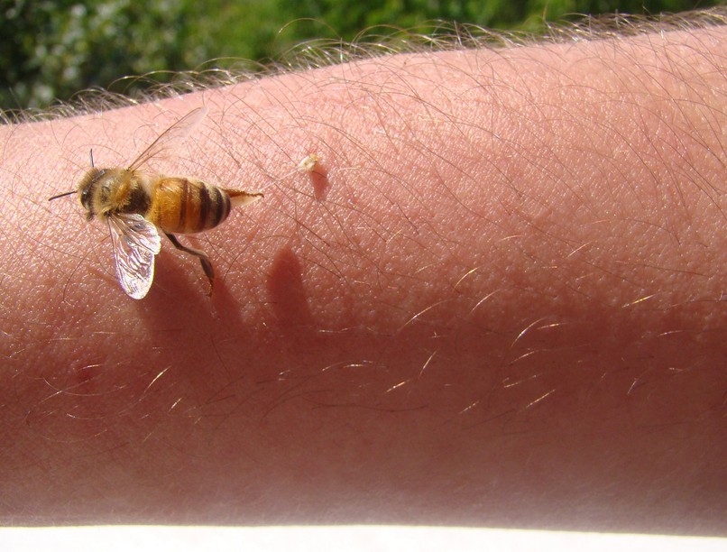 Allergia rovarcsípés után mit kell tenni